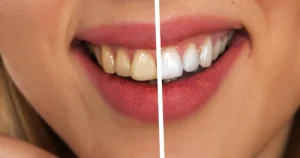 Home Remedies for Whitening Teeth | Top 10 घरेलू उपचार